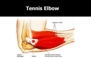 Forearm Pain Near Elbow